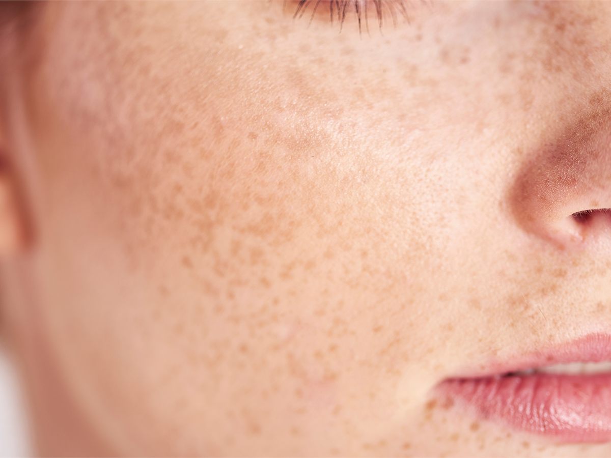 Acne scar treatment consultation at AMAC