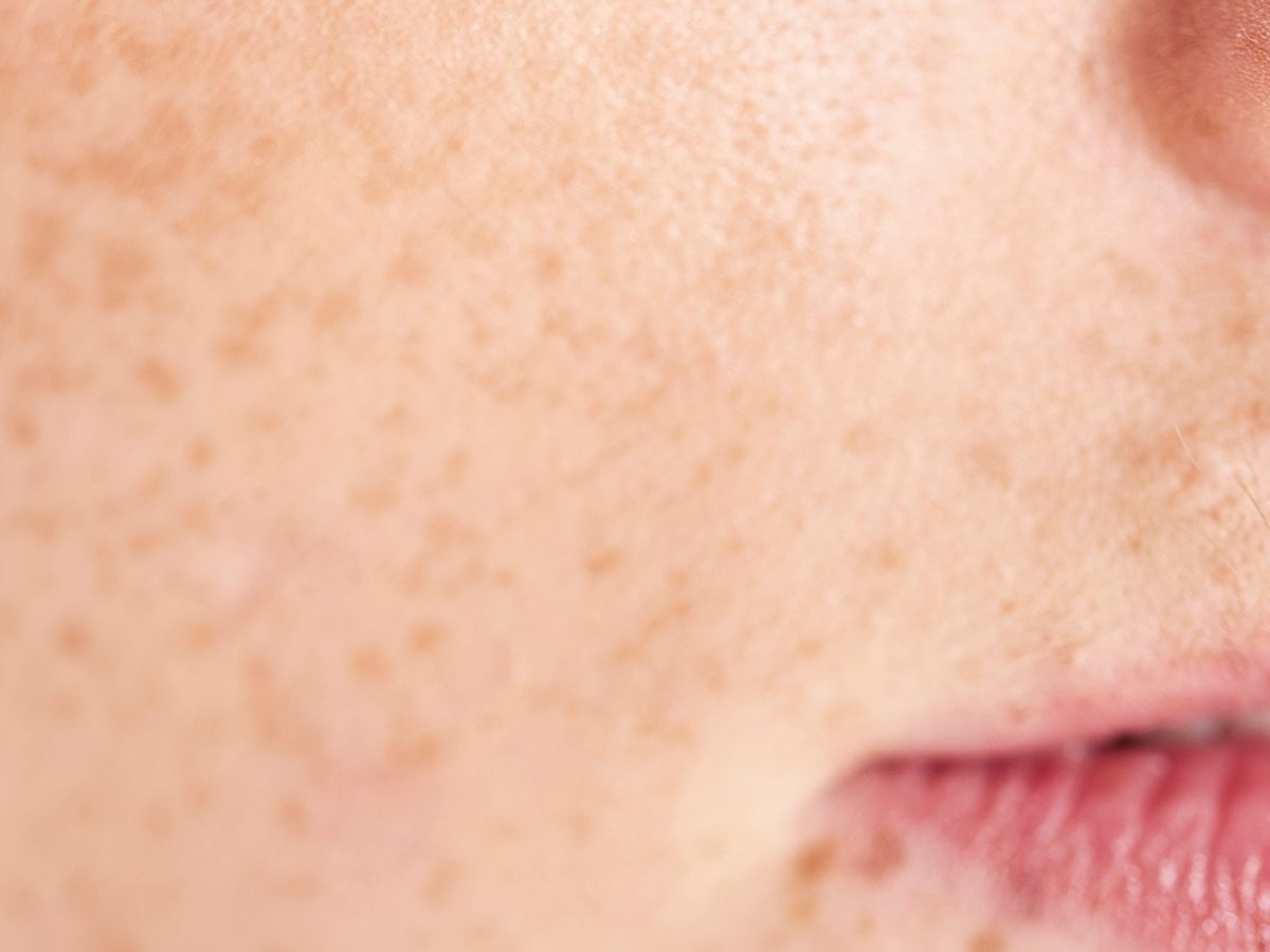 Lip augmentation treatment at AMAC